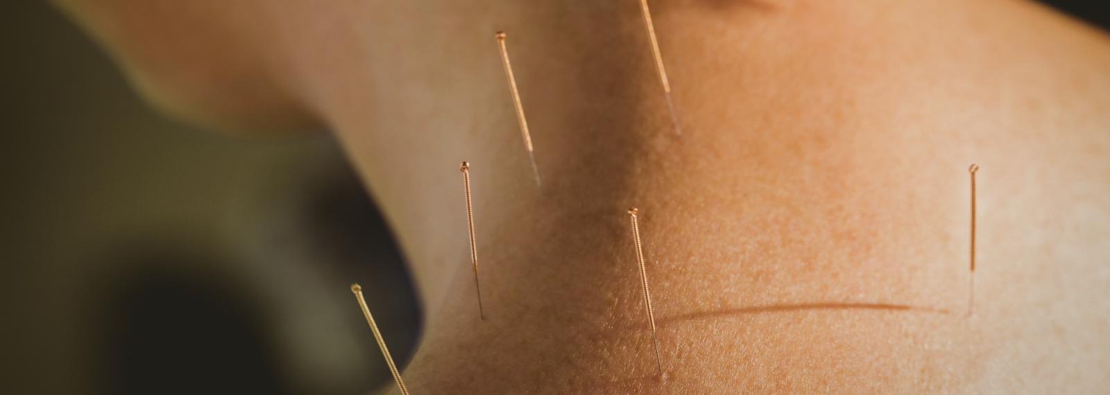 Acupuncture treatment