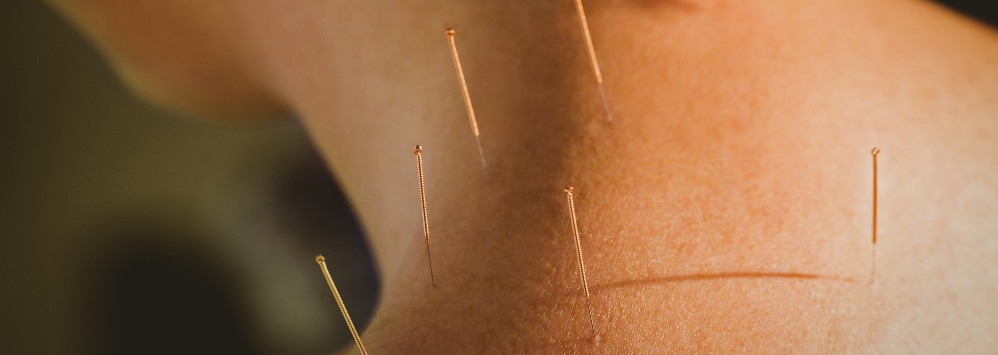 Acupuncture